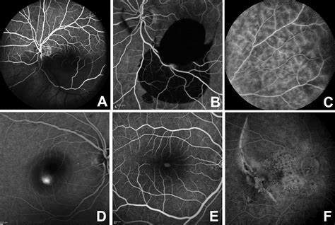 Imaging In Ophthalmology Intechopen