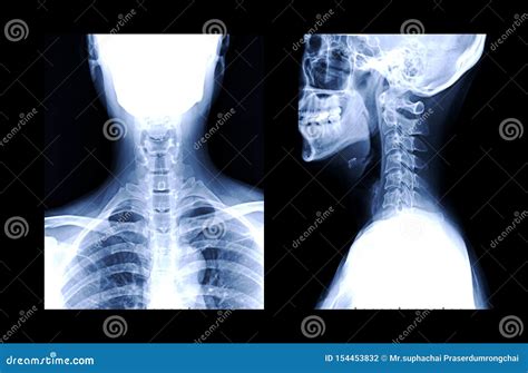C Spine Or X Ray Image Of Cervical Spine Ap And Lateral View Stock