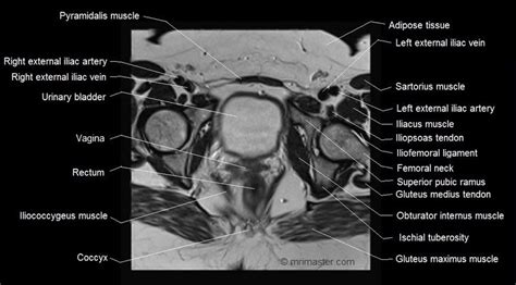 Mri Female Pelvis Anatomy Axial Image Sartorius Muscle Pelvis Anatomy Gluteus Medius