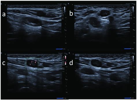 25 Year Old Female With Unilateral Left Axillary Adenopathy Noted 5
