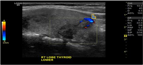 Thyroid Ultrasound Showing Well Defined Mildly Lobulated Solid Lesion