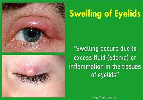 Swollen Eyelids And Eyelid Bump Causes Treatment And More Health Kura