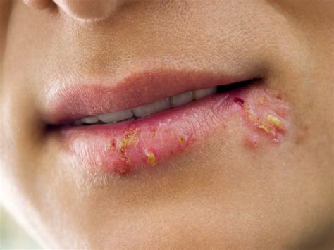 Cold Sores Photos