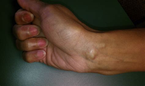 Ganglions And Tumors Of The Hand And Wrist Musculoskeletal Key