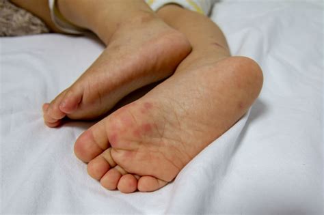 Hand Fuß Mund Krankheit Infektion Und Behandlung Heroldat