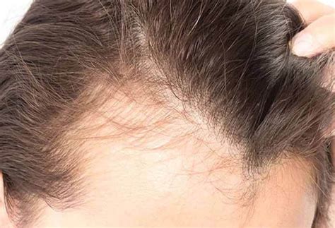The use of vitamin d cream on alopecia patches was investigated in 3 studies. Vitamin D Deficiency Hair Loss Prevent and Hair Grow ...
