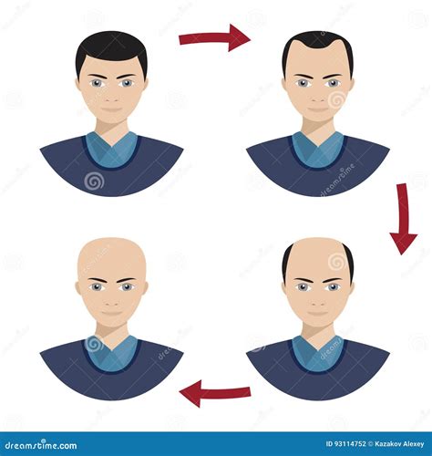 Four Stages Of Hair Loss For Men Stock Vector Illustration Of