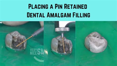 Placing A Pin Retained Dental Amalgam Filling Youtube