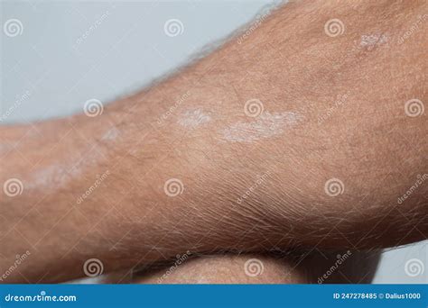 Large Plaque Parapsoriasis On Caucasian Man Legs Stock Image Image Of