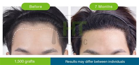 How Do We Make A Natural Hairline Hairtran Clinic