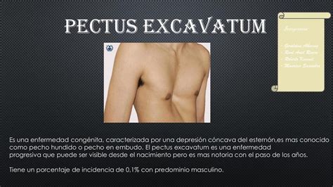 Pectus Excavatum Diana Nicole Soto Bravo Udocz