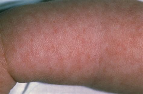 Visual Guide To Childrens Rashes And Skin Conditions Rashes In Images