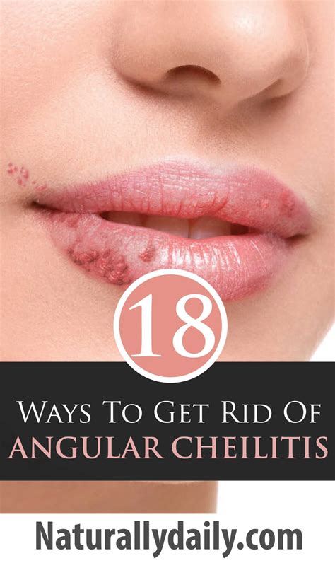 18 Quick Home Remedies For Angular Cheilitis Naturally Daily
