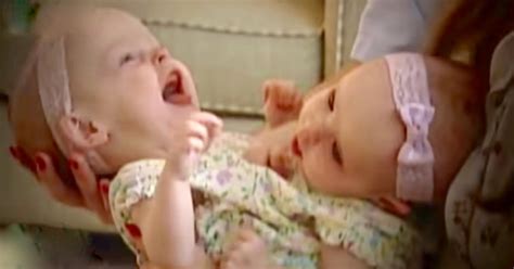 Conjoined Twins Were Famous In 2002 — Eighteen Years Later Theyre Back