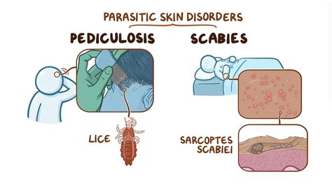 pediculosis and scabies nursing osmosis video library
