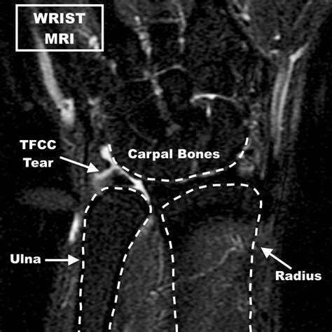 TFCC Wrist Cartilage Tear