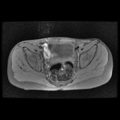 When the articular surface collapses, the patient becomes acutely symptomatic. Avascular necrosis of the hip | Radiology Case ...