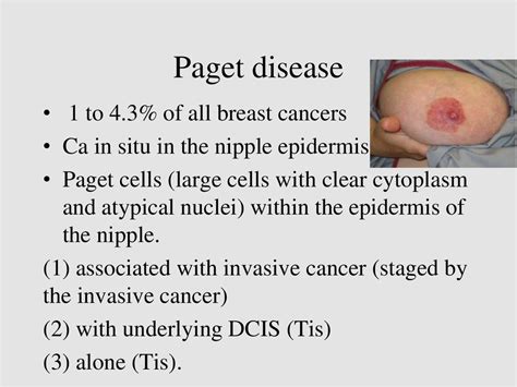 One of the rarer forms of breast cancer, paget's disease of the breast, is involved in about 1 to 4 percent of breast cancer cases in the united states, the national cancer institute reports. Breast cancer - online presentation