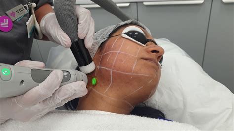Performing Laser Hair Removal Treatment On Face Youtube