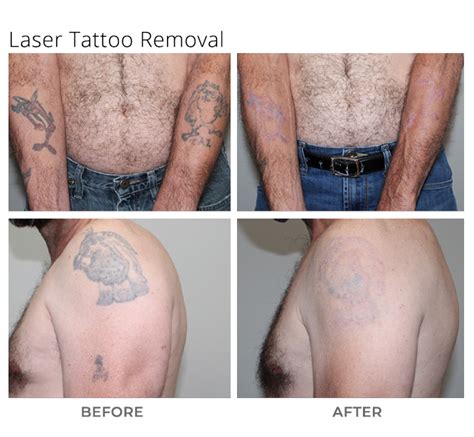 Laser Tattoo Removal Msa Plastic Surgery