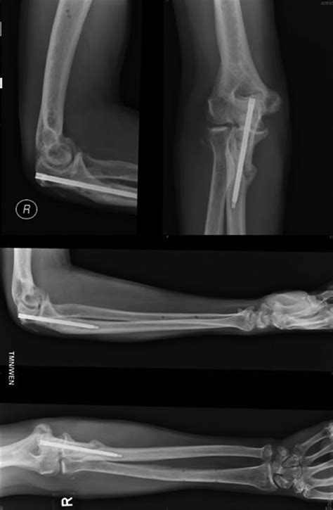 Radiographs Show The Internal Fixation Of The Proximal Ulna Fracture