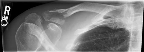Management Of Distal Clavicle Fractures Post Orthobullets
