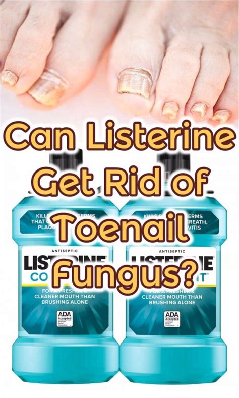 Can Listerine Get Rid Of Toenail Fungus Listerine Foot Soak