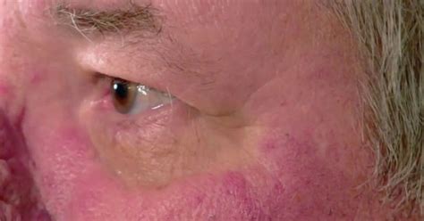 Dr Pimple Popper Rescues Man With Nose So Big It Scared His