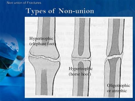 Bone Fractures Nonunion Diagnosis And Management At Shaheed Suhraward