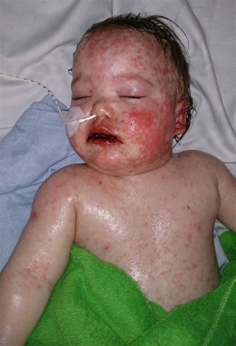 Toddler Almost Dies After Suffering Horrific Allergic Reaction To