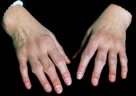 Hands Of A Patient With Rheumatoid Arthritis Photograph By Sue Ford Science Photo Library