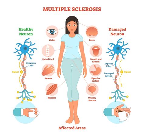 Multiple Sclerosis Sclerosis Specialist In Faridabad Dr Rohit Gupta