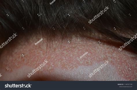 Psoriasis On Hairline On Scalpclose Dermatological Stock Photo