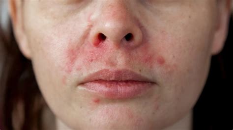 Heat Rash Vs Eczema How To Tell The Difference
