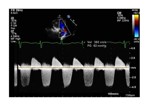 Parasternal Long Axis Pulmonary Valve Pediatric Echocardiography