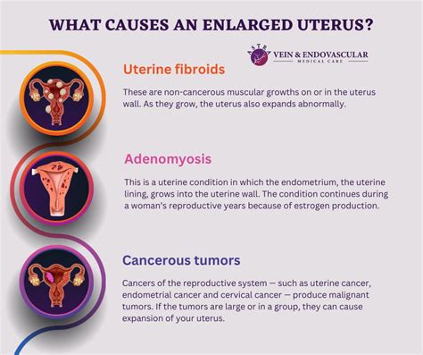 Enlarged Uterus Vein Endovascular Medical Care