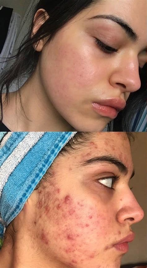 Acne Before And After Transformations Skin Care Acne Anti Aging Skin Care Skin Care Tips