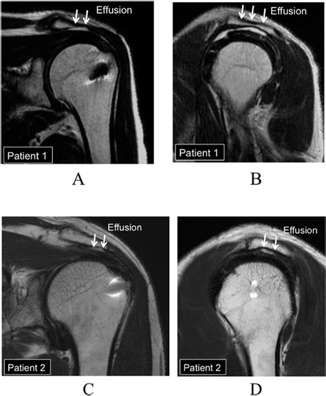 Coronal T2 Weighted Mri 4 Years After Rotator Cuff Repair In Patient 1