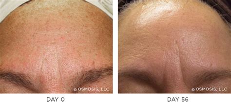 Uneven Tone Pigmentation Before And After Osmosis