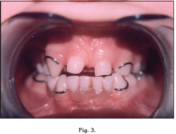Tratamiento odontológico en la displasia ectodérmica Actualización