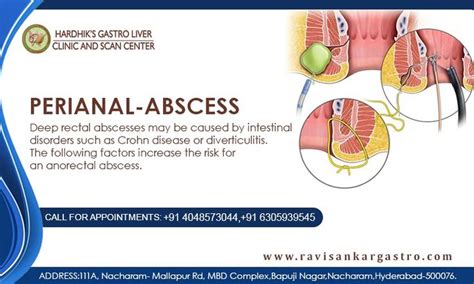 Perianal Abscess Crohns Disease Inflammatory Bowel Disease Rectal