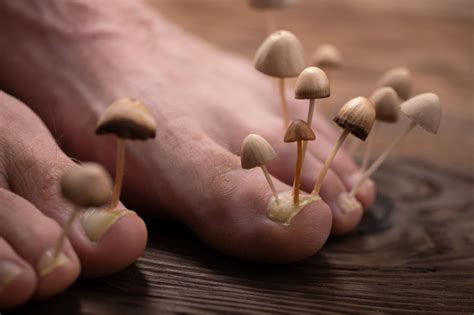 The Different Types Of Foot Fungus That Can Harm Your Feet Piedréseau