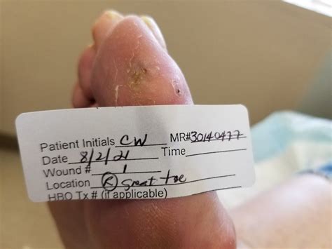 Pin By Connie Woodmansee On Staph Infection Big Toe On Right Foot