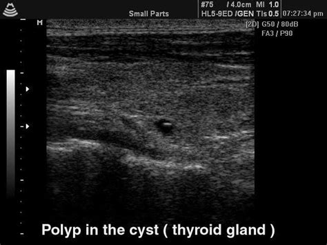 Ultrasound Images • Thyroid Polyp In The Cyst B Mode Echogramm №140