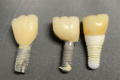 Why Your Dental Implant Fell Out Dr Scott Froum Midtown Nyc