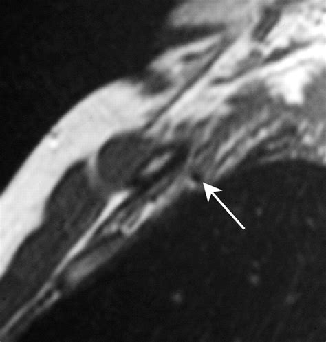 imaging assessment of thoracic outlet syndrome radiographics