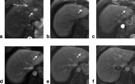 Sclerosed Hemangioma Of The Liver Concordance Of Mri Features With