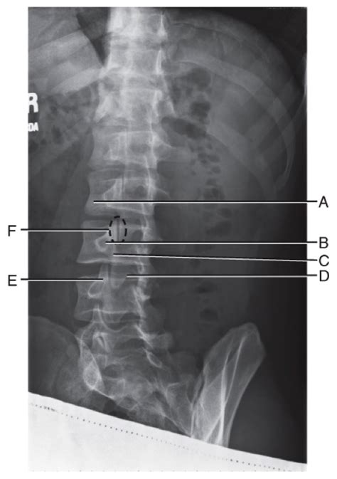 Oblique Lumbar Spine Ch 9 Bontrager Diagram Quizlet