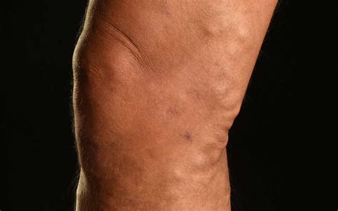 Causes Of Varicose Veins Leg Ulcers