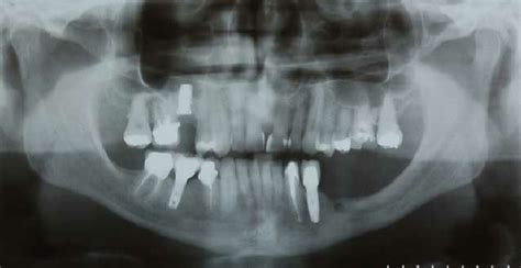 Panoramic Radiograph Showing A Severe Atrophy Of The Mandible In The